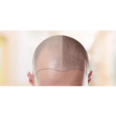 Haartransplantatie bij Hairmen clinics Oosterbeek